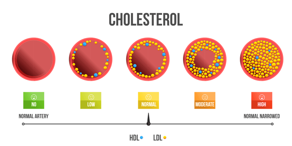 high cholesterol 