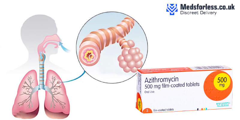 How to treat bronchitis| Buy Azithromycin Online
