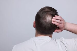 effectiveness of finasteride