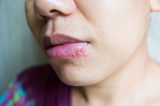 how effective is aciclovir for cold sores
