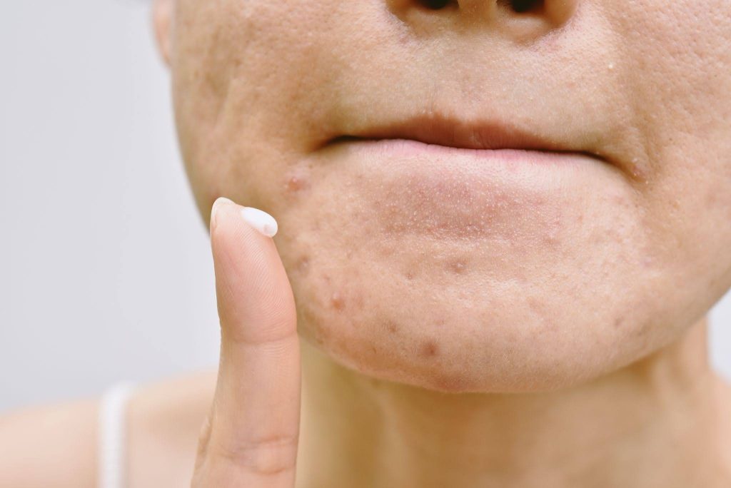 benzoyl peroxide acne treatment
