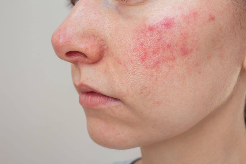 foods that trigger rosacea