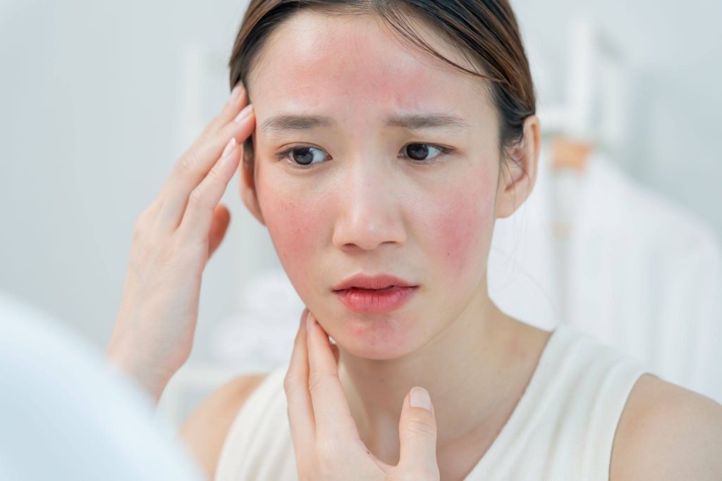 triggers for rosacea