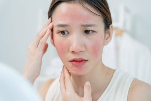 triggers for rosacea