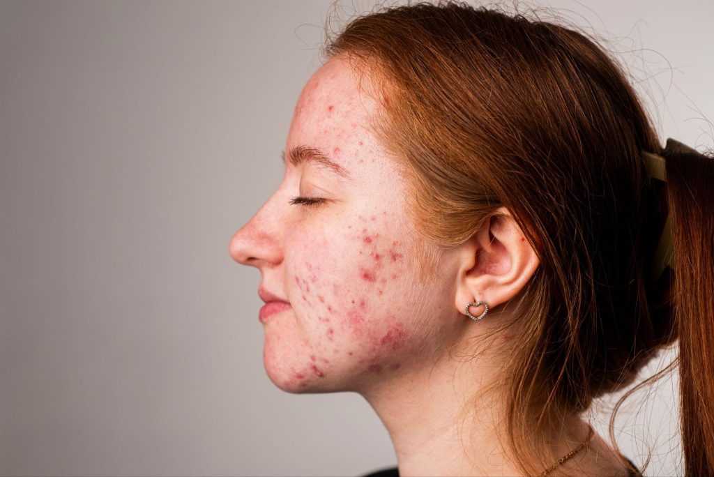 causes of hormonal acne in adults