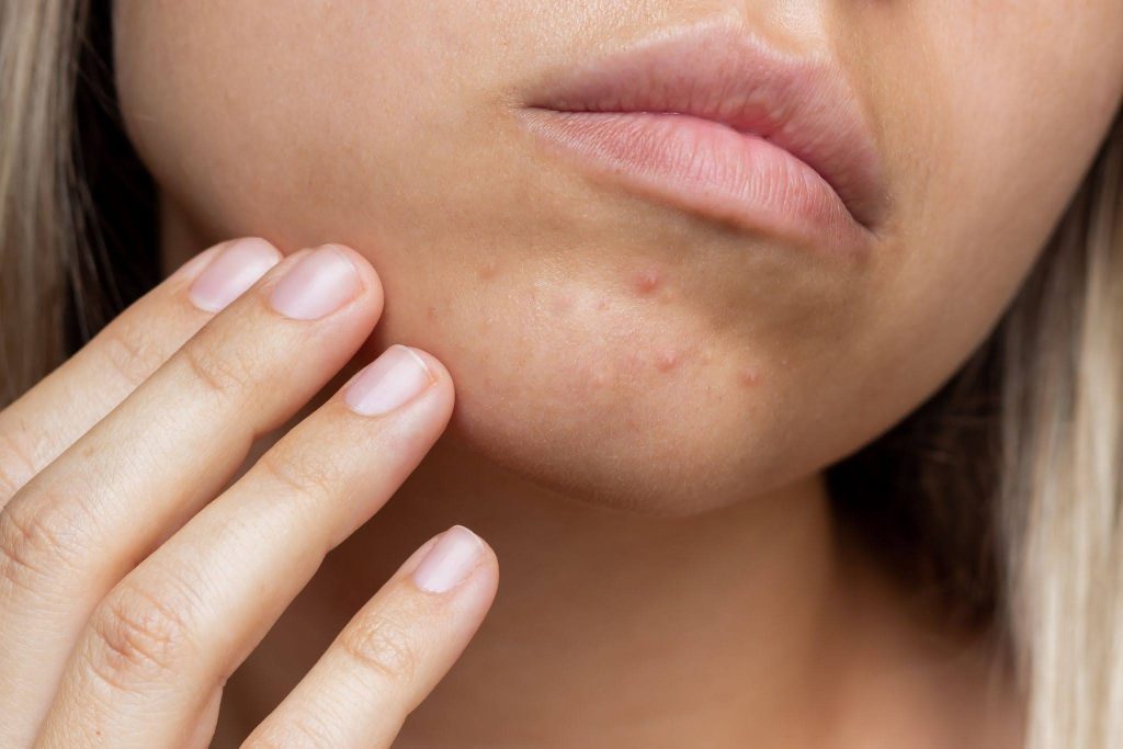 diet and acne connection