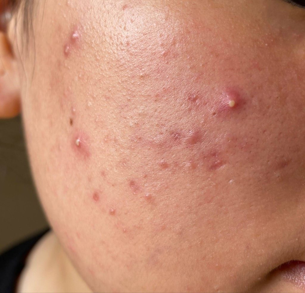 how to treat hormonal acne in adults